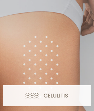 Celulitis